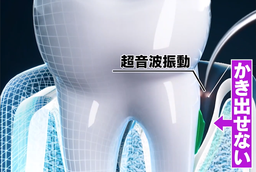 超音波振動：書き出せない