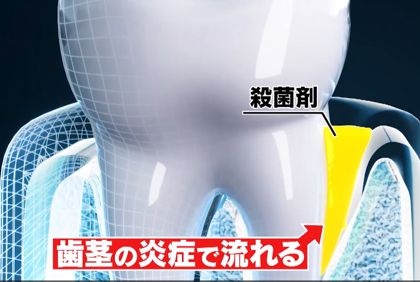 化学療法：殺菌剤流れ出る