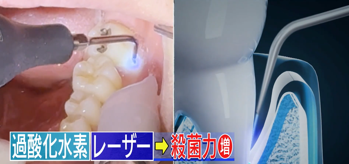 過酸化水素レーザー　殺菌力増